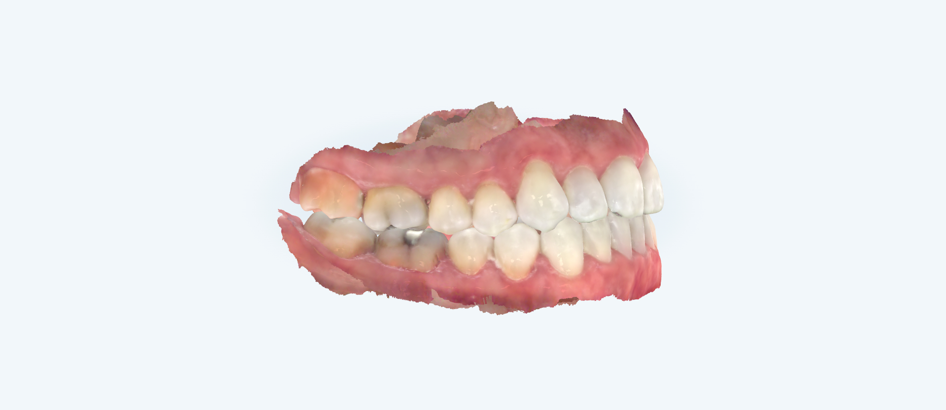Crossbite treatment comparison case 2 after